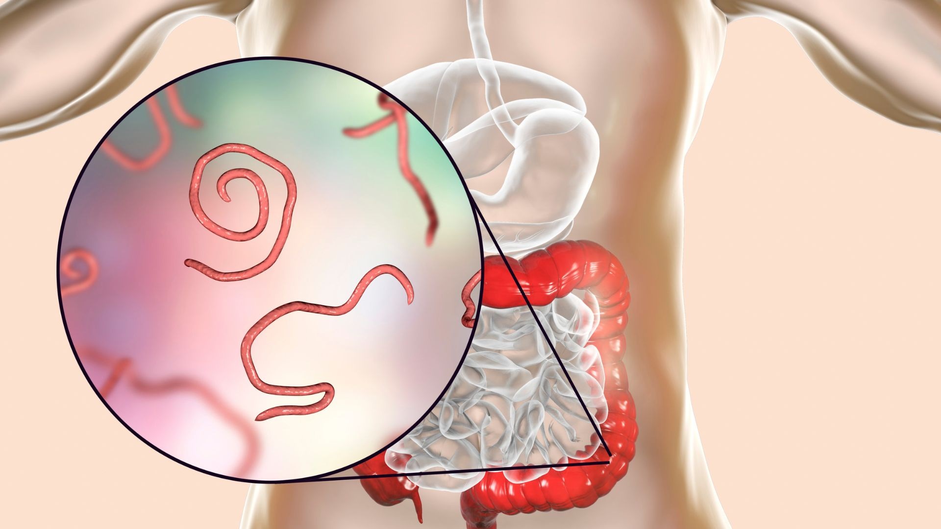 Bệnh ký sinh trùng phổ biến nhất ở Việt Nam và những điều cần biết